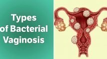 Know if you’ve got a case of bacterial vaginosis