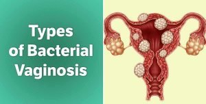 Know if you’ve got a case of bacterial vaginosis