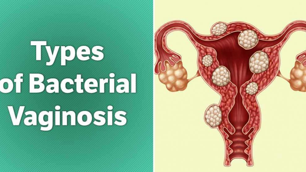 Know if you’ve got a case of bacterial vaginosis